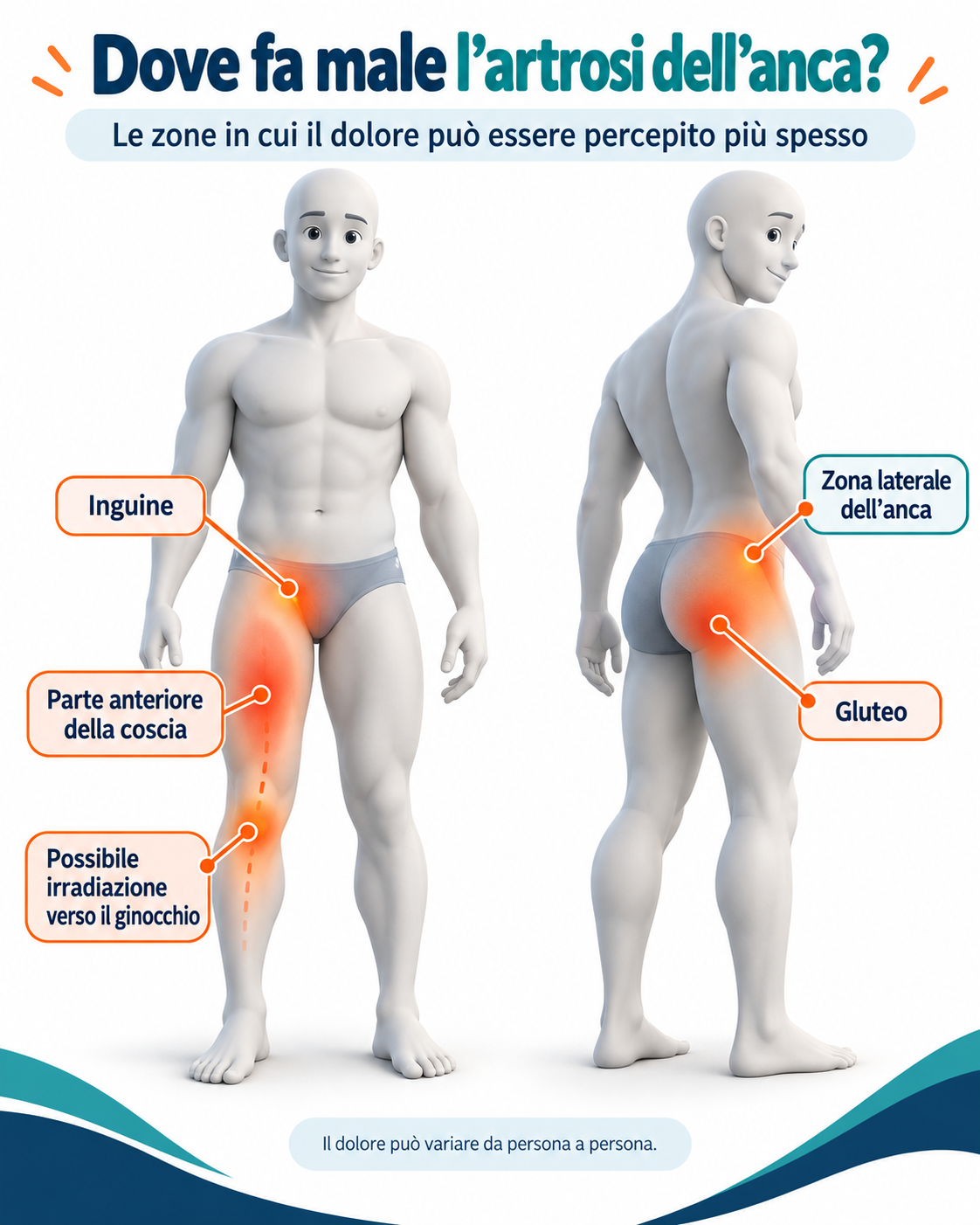 Infografica sulle zone in cui può fare male l’artrosi dell’anca: inguine, parte anteriore della coscia, zona laterale dell’anca, gluteo e possibile irradiazione verso il ginocchio.